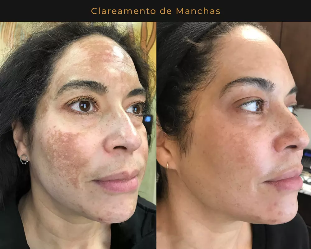 Antes e depois 3